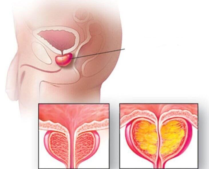 Localización da glándula prostática, próstata normal e agrandada na prostatite crónica