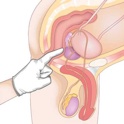 Determinación da condición da próstata por palpación para o diagnóstico de prostatite
