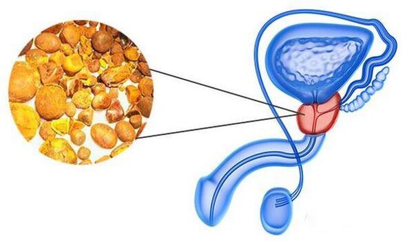 Problemas con prostatite