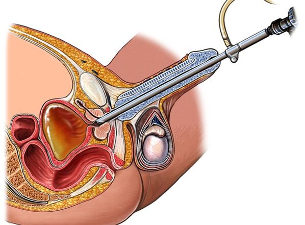 Tratamento da prostatite