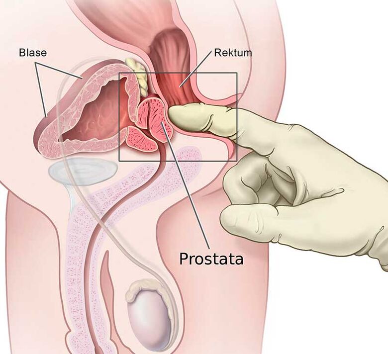 masaxe de próstata para prostatite