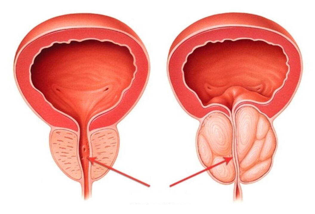 próstata sa e inflamada con prostatite